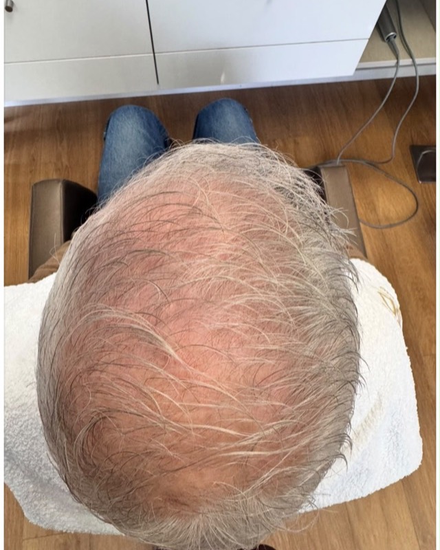 Antes: couro cabeludo de um cliente de 72 anos no início da terapia capilar