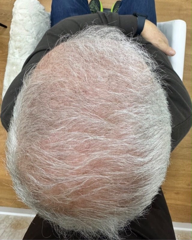 Depois: o mesmo cliente ao fim de três meses de terapia capilar